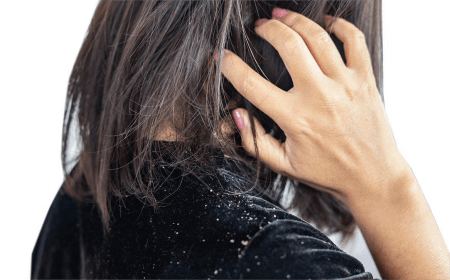a-woman-with-hair-itch-and-dandruff