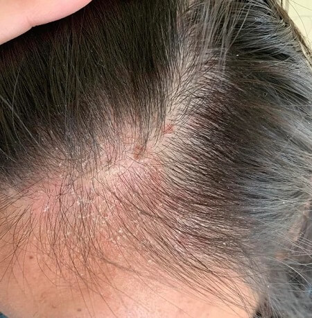 scalp-allergic-reactions