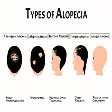 types-of-alopecia-areata