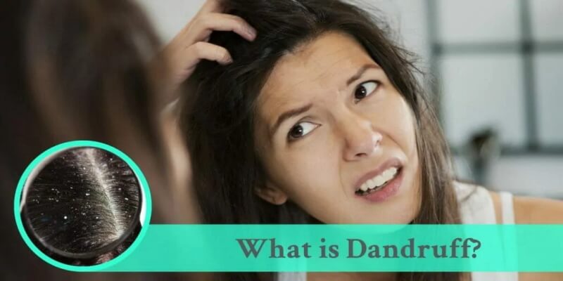what-is-dandruff
